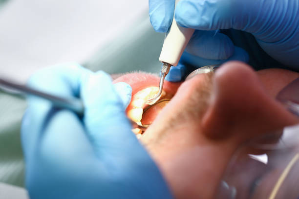 Best Knocked-Out Tooth (Avulsed Tooth) Treatment in Round Lake, IL